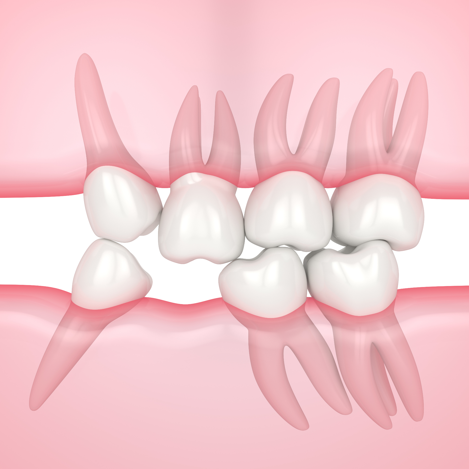 Dental implants and teeth illustration